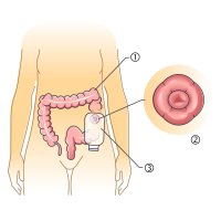 Kolostomie – VectorMine / Shutterstocl