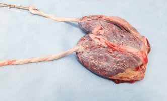 Lidská placenta se dvěma pupečními šňůrami po narození dvojčat – ravipat / Shutterstock