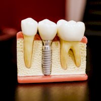 Model zubního implantátu – Jonathan Borba / Unsplash