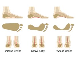 Klenba nožní, zdravá a nemocná noha, ilustrace – Olga Bolbot / Shutterstock